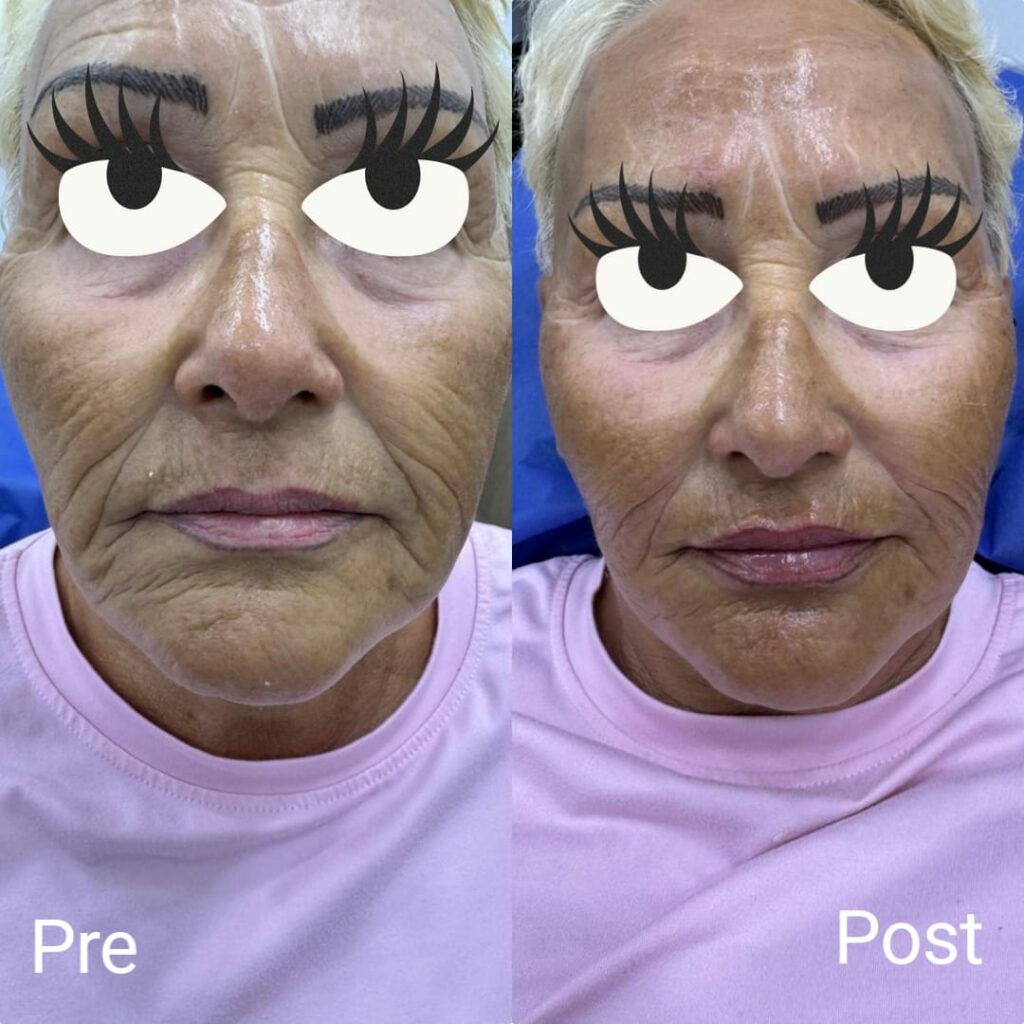 بوتكس مكافحة الشيخوخة